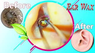 Ear Wax Removal Myths Debunked What You Need to Know 077 [upl. by Kinemod]