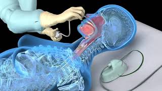 Nasotracheal suctioning NTS  3D animation [upl. by Vivica]