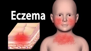 Eczema Animation [upl. by Nick]