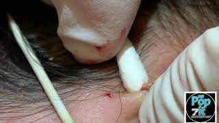 Your new favorite extraction video part 1 Blackheads whiteheads milia Over 20 minutes of pops [upl. by Annora]