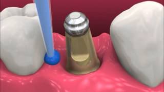 Smyl Manatee  Dental Implant Procedure [upl. by Lindley]