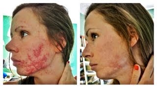 How We Got Rid of Our Acne  Accutane Isotretinoin Experience [upl. by Hamaso]