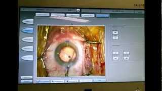 CALLISTO Eye system  Chirurgie de la cataracte Dr Coullet Montpellier [upl. by Shandie]