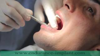 refaire toutes ses dents implant dentaire [upl. by Ahsercul]