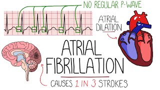 Atrial Fibrillation Made Easy Complete Overview [upl. by Annette]