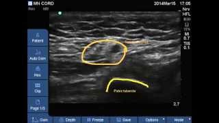 UltrasoundSpermatic cord for cord block [upl. by Clava]