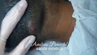 CISTO SEBACEO OU EPIDERMICO quotAndrea Pimentel neuroestéticaquot [upl. by Dermott]