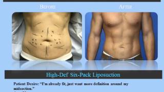 Male liposuction before and after photos of NYC patients [upl. by Ferreby979]