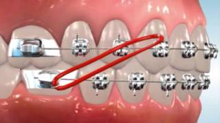 Class 2 Elastics  Easton Ortho 101 with Dr Loftus [upl. by Adigun620]