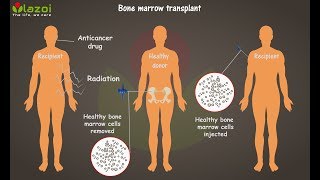 What is Bone Marrow Transplant  Complete guide about bone marrow transplantation lazoicom [upl. by Lashonde]