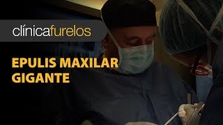 Epulis maxilar gigante [upl. by Jaeger]