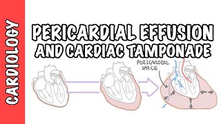 Cardiac Tamponade  pericardial effusion causes pathophysiology investigations and treatment [upl. by Selim]