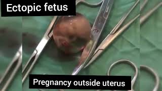 DNC of ectopic pregnancy Fetus is still alive moving in water bag😭 [upl. by Annekim]