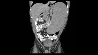 Hepatomegaly amp splenomegaly Hepatosplenomegaly by profMarwa AlEmam [upl. by Egas]