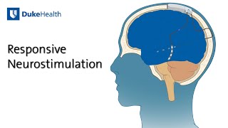 Responsive Neurostimulation RNS for Epilepsy  Duke Health [upl. by Tome]