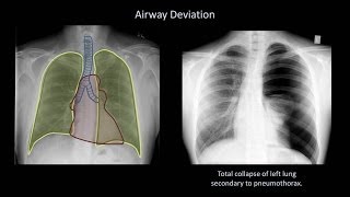 How to Interpret a Chest XRay Lesson 4  Airways Bones and Soft Tissues [upl. by Brenza282]