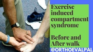 Exercise Induced Compartment Syndrome Signs and Symptoms [upl. by Prentiss]