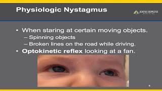 Nystagmus  A Patient Guide [upl. by Alfredo585]