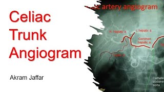 Radiographic Anatomy  Celiac Trunk Angiogram [upl. by Adiela]