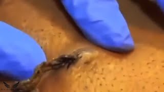 Severe Elderly Blackhead Removal  Cystic Acne Whitehead Treatment  Spa Relaxing Facial Acne  141 [upl. by Mcginnis]