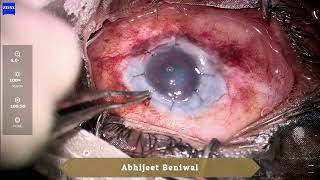 Optical penetrating keratoplasty in Xeroderma Pigmentosum [upl. by Nairbal675]