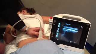 Ultrasound Guided SI Joint Injection  How To [upl. by Mastrianni847]