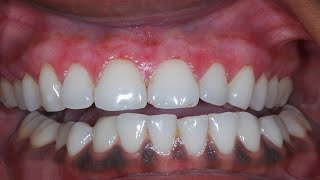 Black Gums  How to Get Rid of Black Gums  How to Get pink Gums [upl. by Fabrienne746]