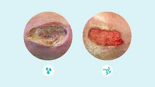 How to assess wound exudate [upl. by Rorie809]