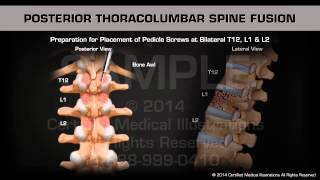 Posterior Thoracolumbar Spine Fusion Surgery [upl. by Revkah]