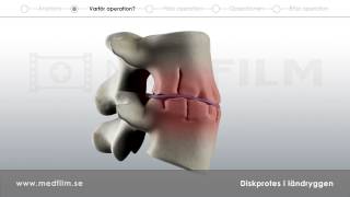 Patientfilm om diskprotes i ländryggen [upl. by Ylatfen]