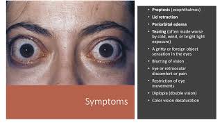 Thyroid Eye Disease [upl. by Lleon]