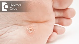 How to treat foot corn amp warts  Dr Rasya Dixit [upl. by Cissy]