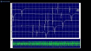 Kimura amp Kohara F18 Transition of positive sharp waves to fibrillation potentials [upl. by Strickland]