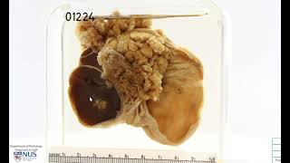 Ultrasound of common ovarian pathology [upl. by Naid]