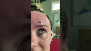 Cystic Acne Extractions Whiteheads  Blackheads Removal Today [upl. by Aserehtairam529]