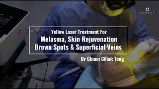 Yellow Laser Treatment for Melasma Skin Rejuvenation Brown Spots and Superficial Veins [upl. by Let]