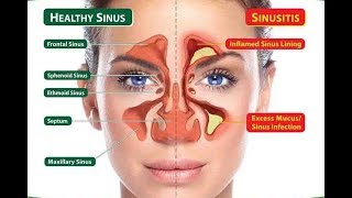 NATURAL TREATMENT for SINUSITIS  CURE  PERMANENT RELIEF  Amitabh Pandit [upl. by Ekim]