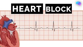 Heart Block  AV Block  ECG  EKG  OSCE Guide  UKMLA  CPSA [upl. by Ynettirb]