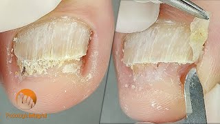 2 cases 1 video XI  1 Onychomycosis  2 Onychogryphosis Podological treatment [upl. by Karrah]