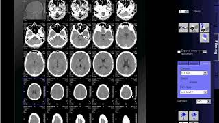 CT Scan of Brain flimingSIEMENS [upl. by Noreht]