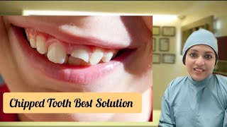 Chipped Tooth Repair l Chipped Teeth Treatment l Chipped tooth filling [upl. by Olenka331]