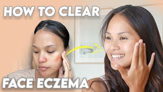 Get Rid of Facial Eczema lifechanging tips [upl. by Holub]