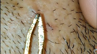 Largest ingrown hair removal on face [upl. by Lowenstein]