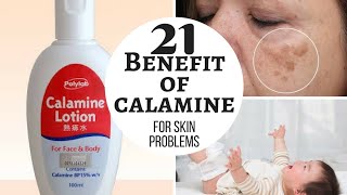 CALAMINE lotion  Lacto calamine lotion uses in detail side effects [upl. by Llezom]