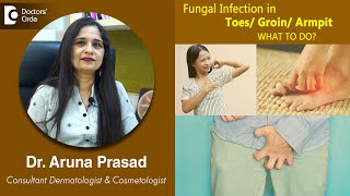 FUNGAL INFECTION in your TOES GROIN ARMPIT Causes Symptoms and Treatment  Dr Aruna Prasad [upl. by Wenger]