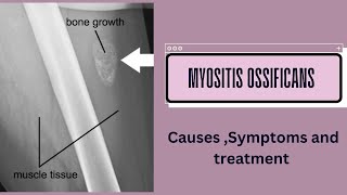 Myositis ossificans [upl. by Azelea]