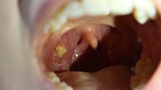 GROSSEST VIDEO EVER  Tonsil Cyst Popping [upl. by Eelac]