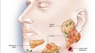 salivary gland tumors [upl. by Stedt191]