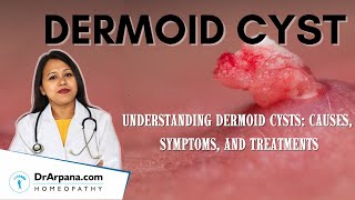 Understanding Dermoid Cysts Causes Symptoms Diagnosis and Management in HOMEOPATHY [upl. by Lindell794]