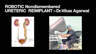 Robotic Non dismembered Ureteric reimplant [upl. by Tteirrah]